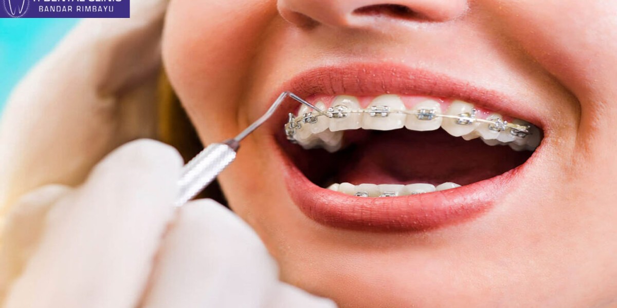 Teeth Veneers: Factors and Considerations